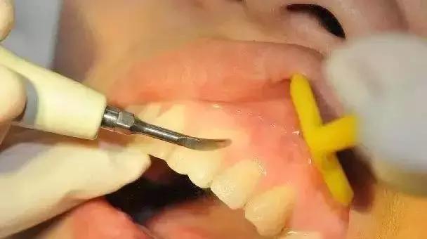 深度洗牙和普通洗牙,洗牙深度洁治和上药大概多少钱