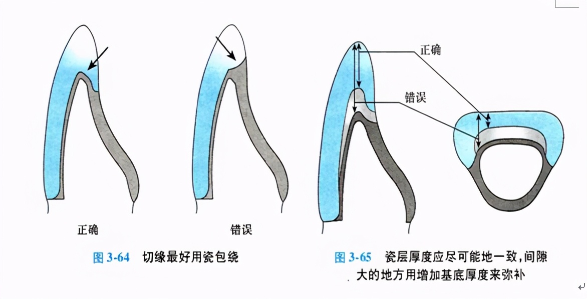 口腔金属冠与全瓷冠的区别,牙科医生讲义