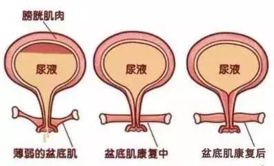笑得尿失禁怎么办,笑会流尿出来是什么原因