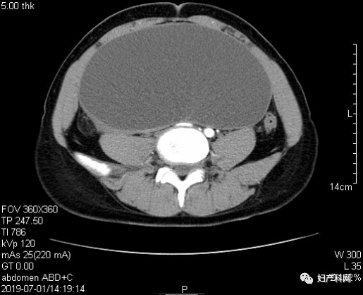 子宫内膜异位囊肿报告如何看,病理报告显示卵巢子宫内膜囊肿