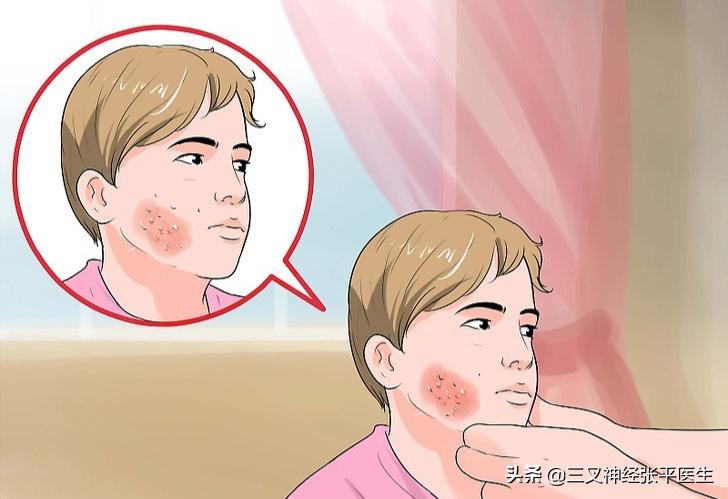 带状疱疹三叉神经痛后遗症,带状疱疹后三叉神经痛怎么治疗