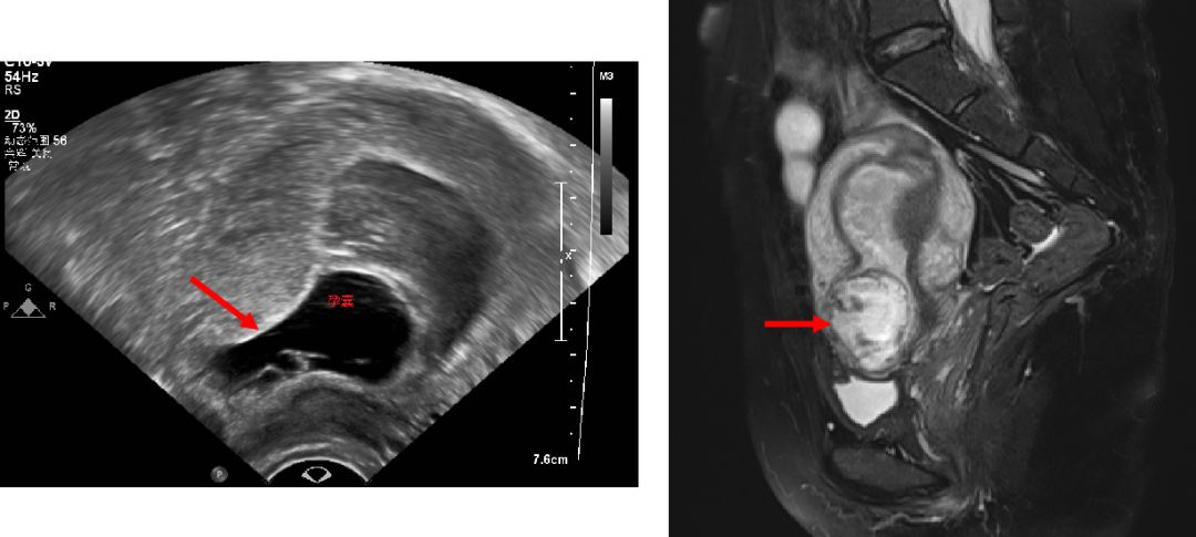 「健康说」女神节专辑：剖宫产瘢痕妊娠知识宝典