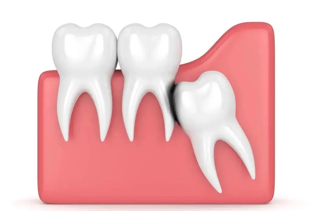 拔牙一个月后牙洞酸酸的难受,拔上牙智齿容易得干槽症吗