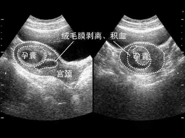 孕中期宫腔积液形成血肿了,绒毛膜下血肿和积液