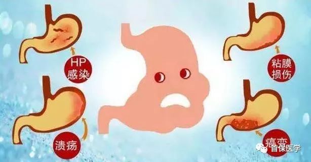 幽门螺旋杆菌需要空腹么,幽门螺旋杆菌你了解多少