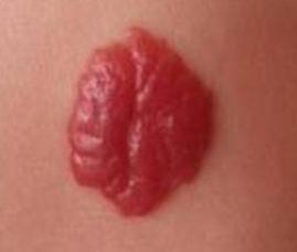 百天宝宝患有血管瘤,激光、敷药该如何抉择?愁坏妈妈