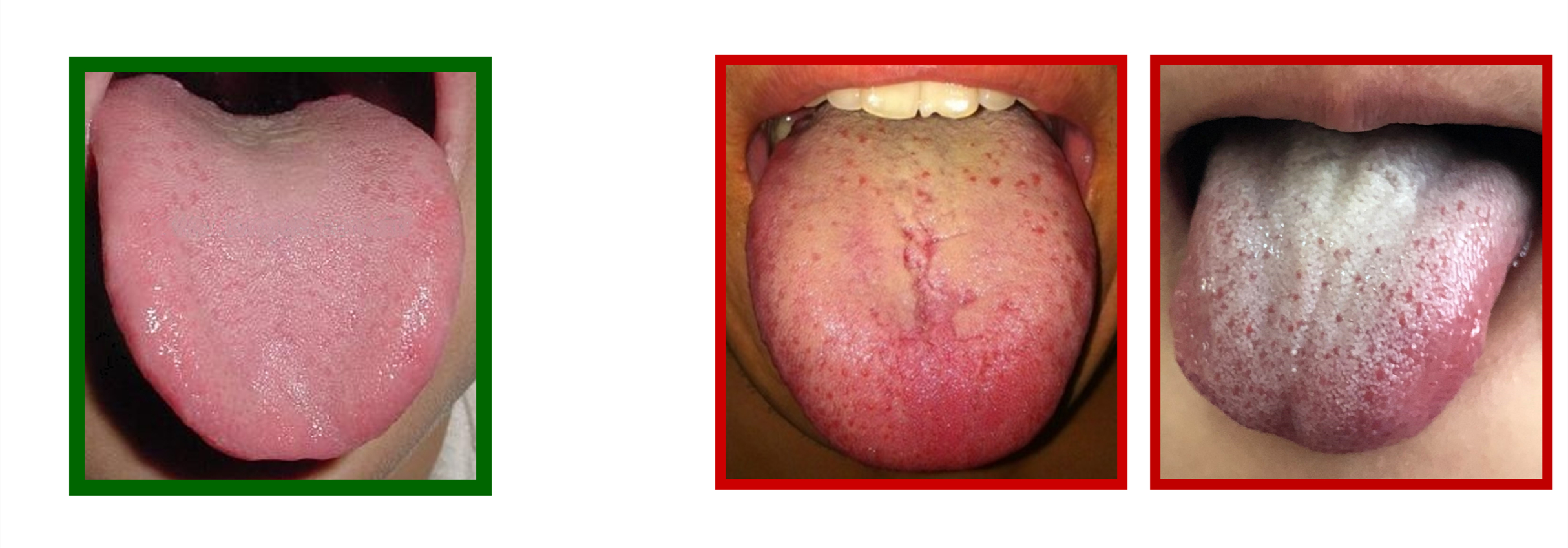 小孩打新冠疫苗发烧怎么办,儿童打过新冠疫苗发烧了怎么办