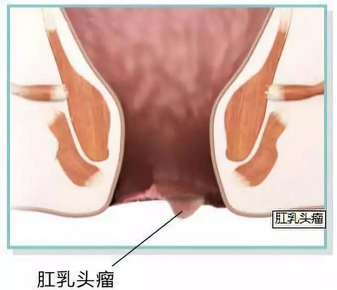 肛门异物感是怎么回事