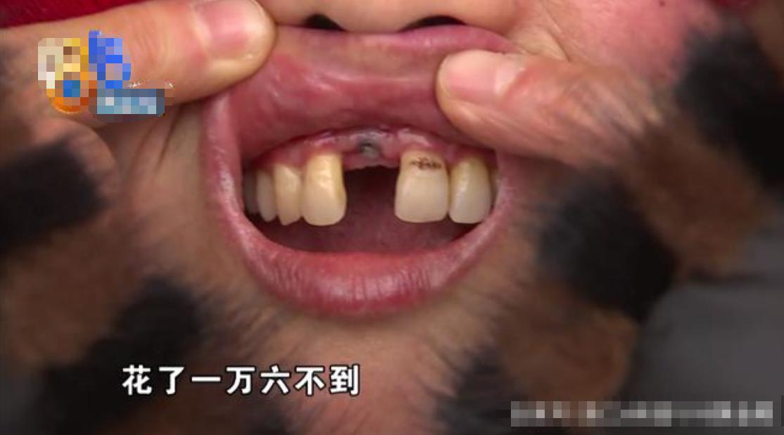 中老年种植牙5年后真实感受,老年人种植牙亲历