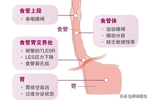 胃食管反流药物治疗一般多久好,胃食管反流需要吃几个疗程的药
