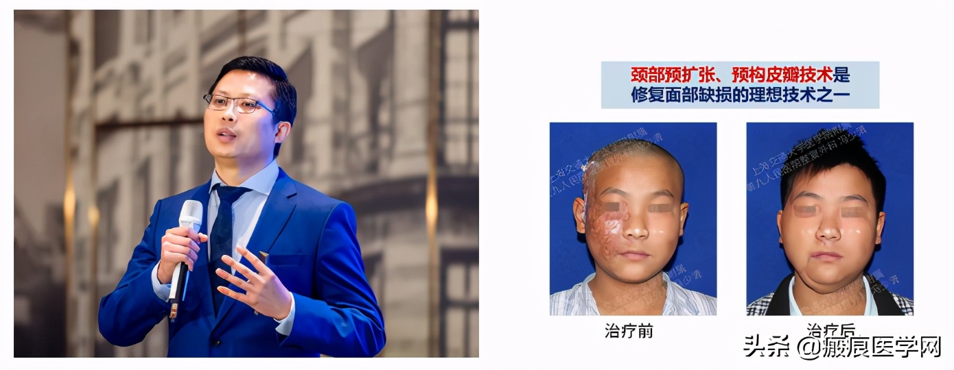 鐦㈢棔妗堜緥,鐤ょ棔娌荤枟鎴愬姛妗堜緥