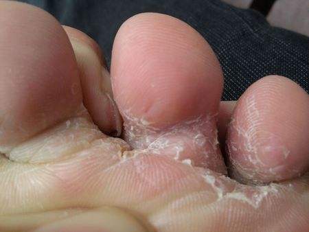 一到夏季脚气犯了怎么办,香港脚教你一招解决脚气