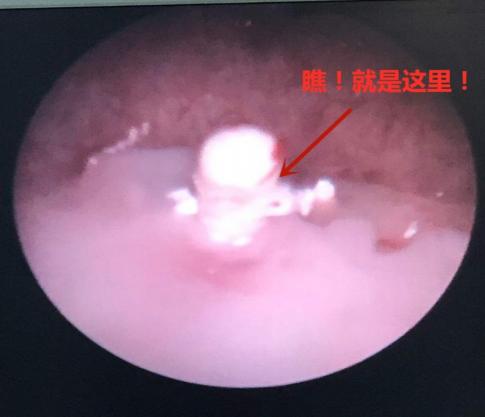 女性节育环不取会导致膀胱炎吗,罕见宫内节育器居然成了膀胱结石