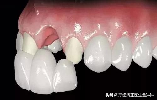 烤瓷牙不密合会导致牙疼吗,烤瓷牙不密合是什么原因引起的