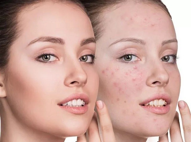 敏感肌肤容易长痘痘怎么修复,痘痘敏感肌适合用哪种护肤品