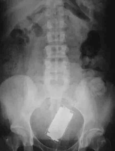 不作死就不会死,看看这些被人类搞进身体里的异物