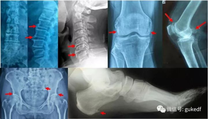 长骨刺的根本原因是什么怎么解决,骨刺到底是不是病