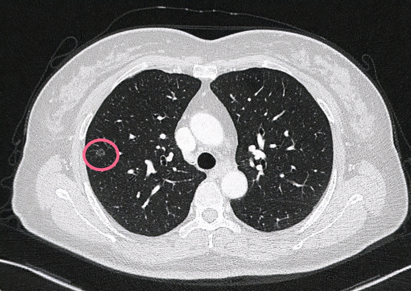 问诊分析：右下肺占位伴多发小结节，如何考虑？