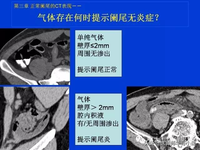 阑尾炎课件,阑尾炎的超声课件