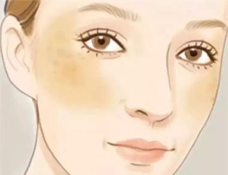 褐斑是什么样子的图片,褐斑是不是黄褐斑