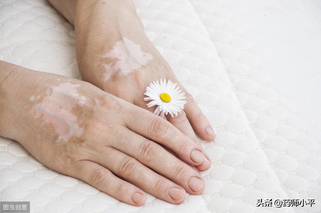 冯小刚对于白癜风的事情怎么说,冯小刚谈自己得白癜风