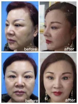 面部支架手术危险吗,做完面部支架有什么注意事项