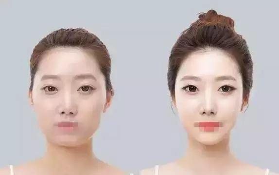 明星注射玻尿酸案例,注射玻尿酸变美