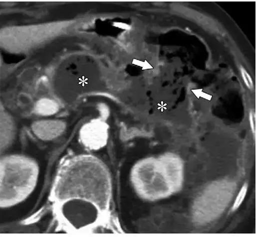 简述急性胰腺炎影像学表现,有关急性胰腺炎疼痛的图片