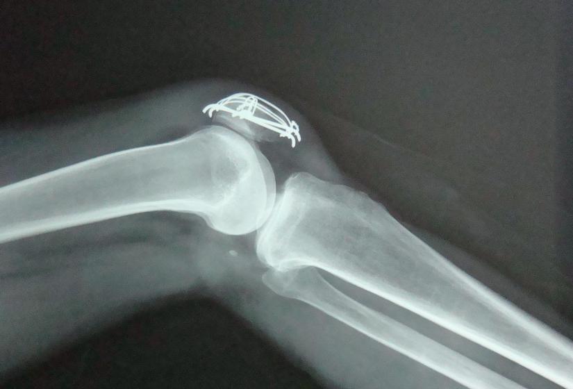 膝关节疼痛有积液用什么中药治,膝关节疼痛有积液解决方法