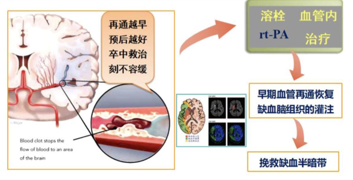 老人脑血管堵塞最快消除方法,如果脑血管有斑块怎么治疗