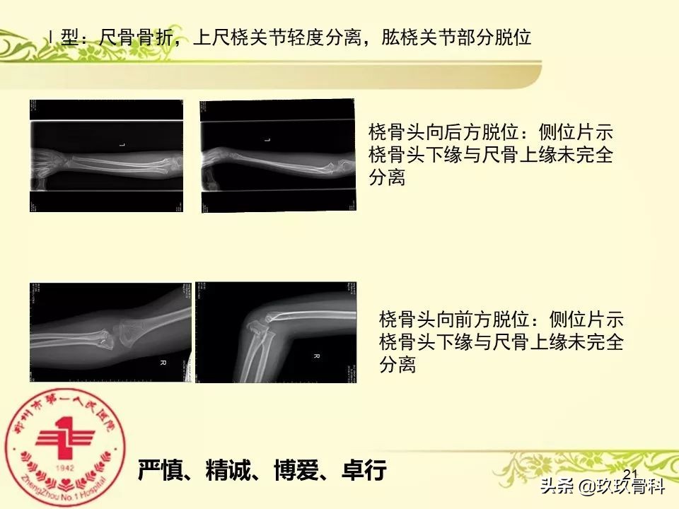 孟氏骨折功能训练多久能恢复正常,孟氏骨折中医能治吗