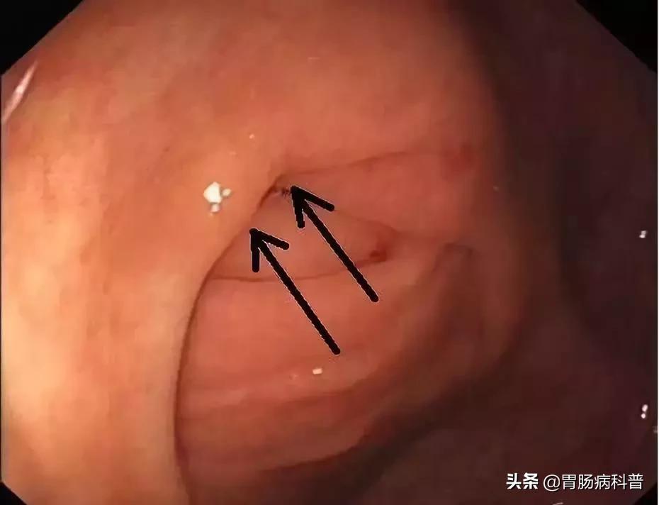 阑尾炎最新内镜微创手术,内镜下阑尾炎治疗术哪里可以做