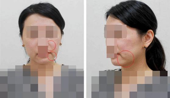 脸松弛下垂法令纹做什么医美手术,法令纹苹果肌下垂做什么手术