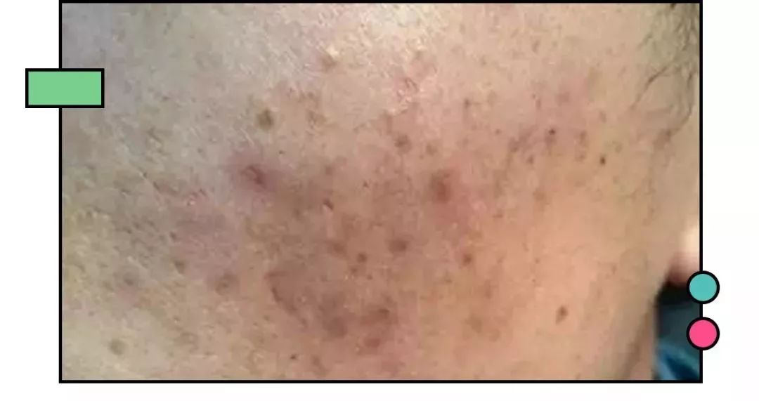 痘印多久才能消如何快速消除痘印,如何有效祛痘印看完你就知道了