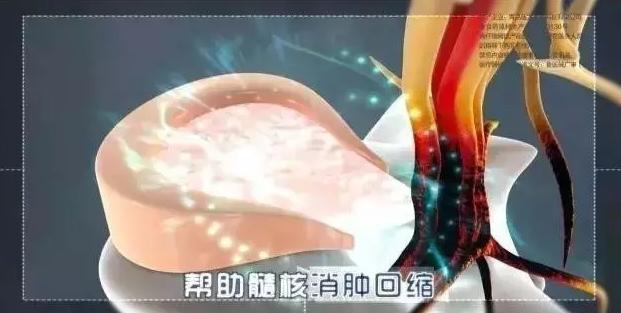 铁腰板治腰突效果怎样,腰突治疗仪铁腰板多少钱