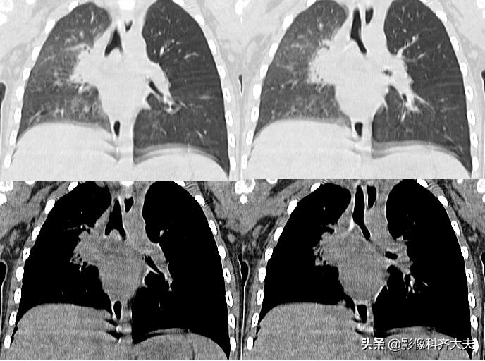 小儿气管镜怎么检查,小儿ct检查全过程视频