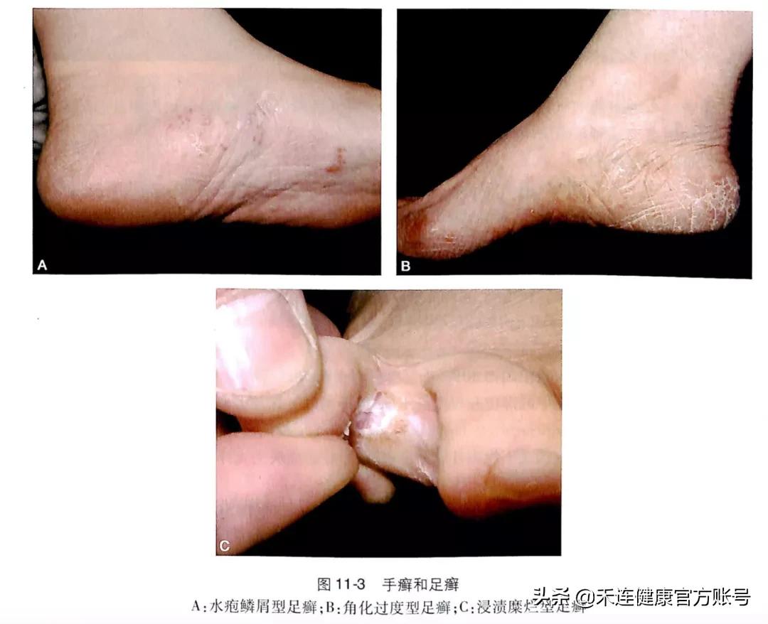 脚痒、水疱≠脚气,3招教你搞定,尤其注意这些细节