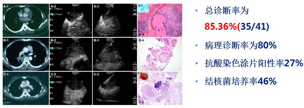 孙加源门诊,治疗肺癌的新技术新手段