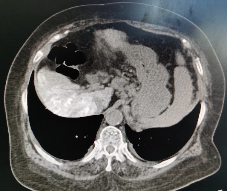 黄婶的肝癌用介入治疗已经3年多了-适合自己的治疗才是最好的治疗