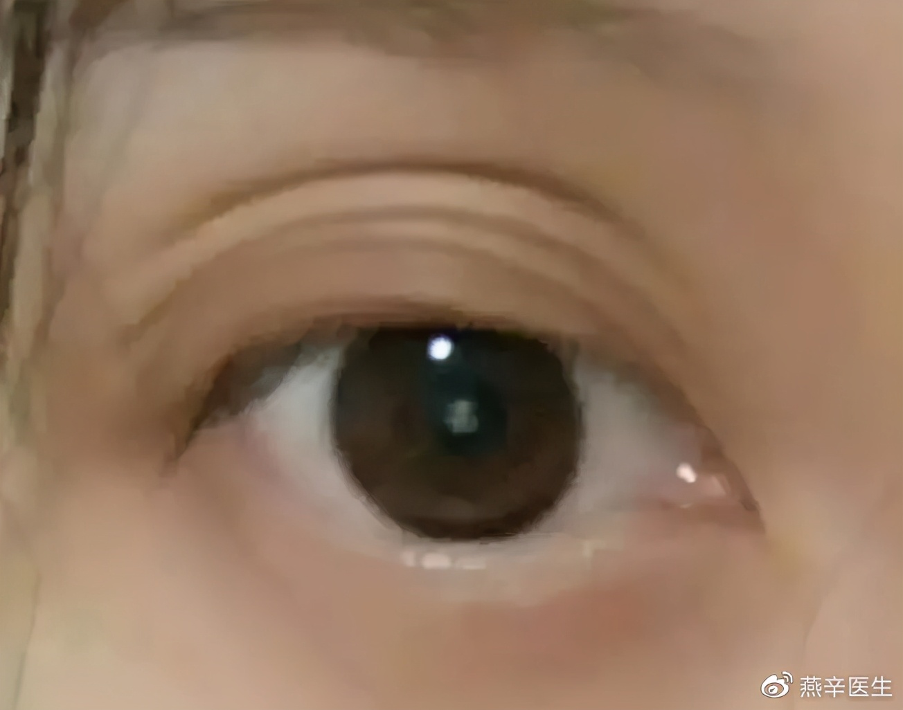 眼皮皱褶多是怎么回事？适合做双眼皮吗？