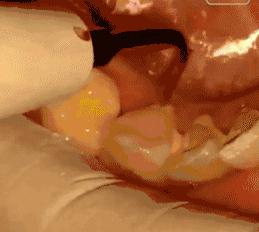 牙结石是每个人都会有的吗,牙结石是每个人都会有的嘛