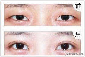 眼睛无神呆滞怎么好得快,眼睛无神呆滞怎么变好图片