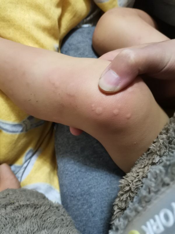 宝宝身上起好多疙瘩，跟蚊子咬的差不多，很痒，怎么办亲身经历