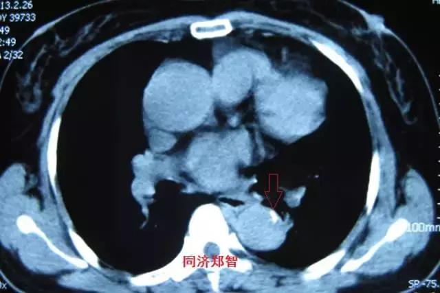 磁共振可以替代cta检查主动脉夹层,主动脉夹层cta上如何分辨真假腔