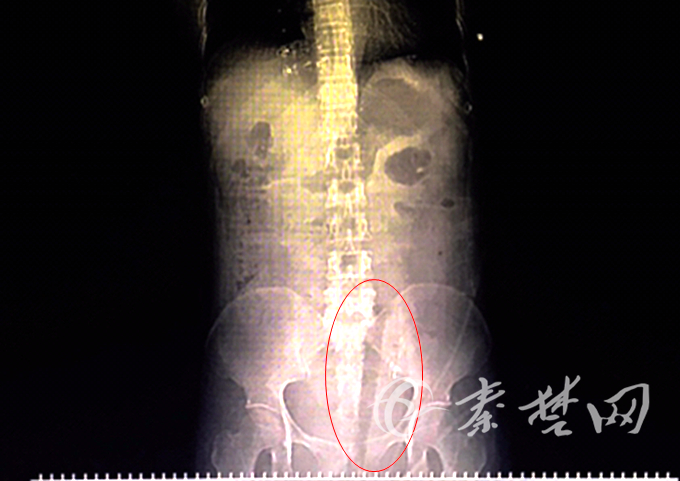 十堰女子上树摘樱桃跌落灌木丛30厘米长断枝插进*体下**