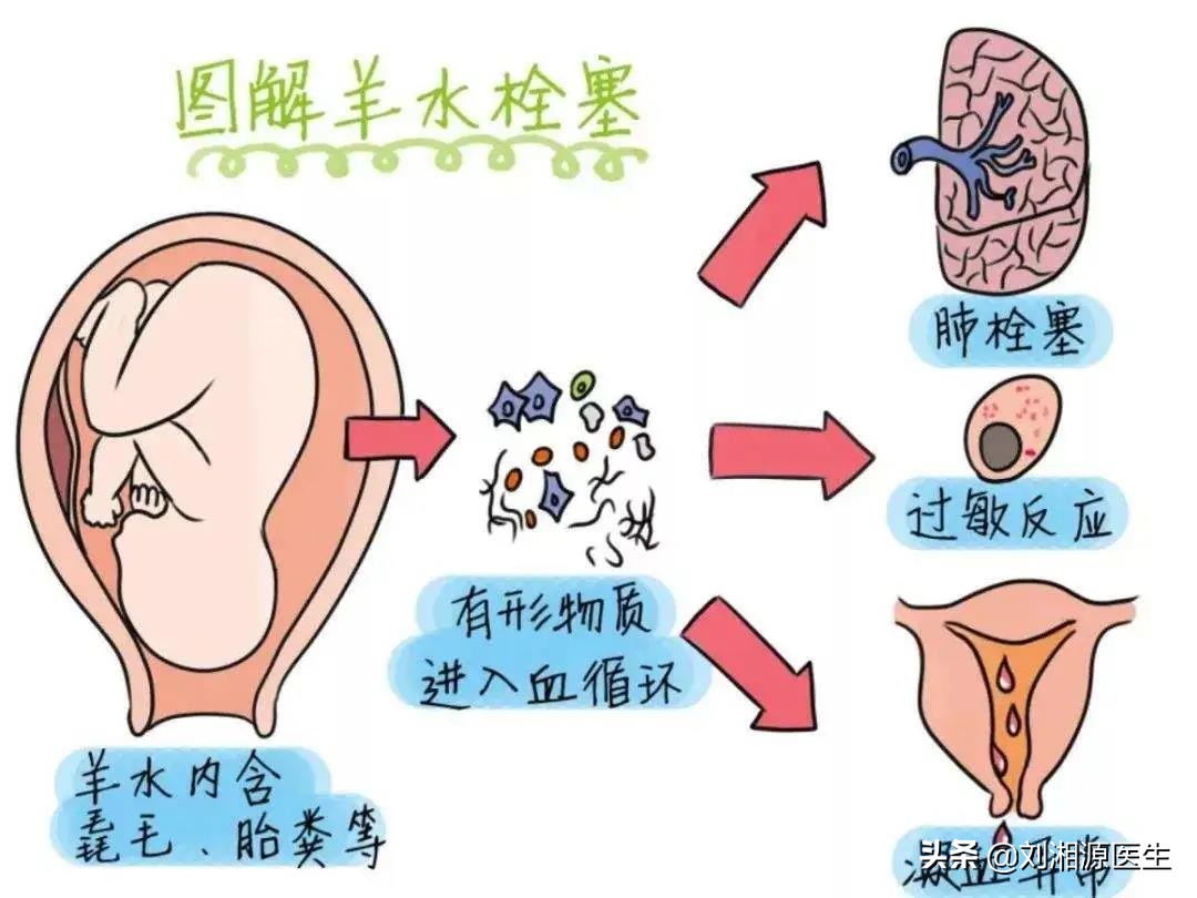 免疫性不良妊娠保胎成功,免疫治疗不良妊娠的方法
