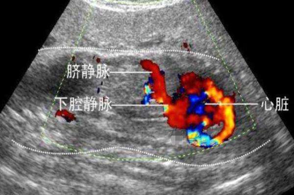 四维检查胎儿双肾不在一个水平面,四维彩超可以做出胎儿肾脏畸形吗
