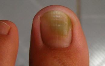 怀孕初期有灰指甲怎么办,怀孕期间灰指甲怎么治