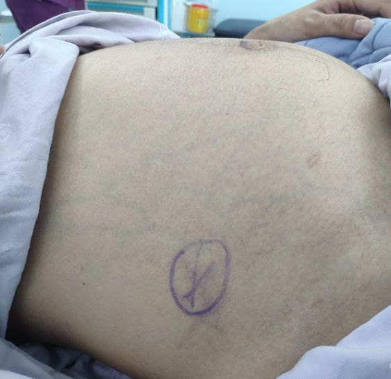 孕早期44天急性化脓阑尾炎该咋办,阑尾炎保守治疗中腹痛