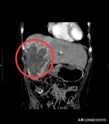 一位患者的真实抗癌经历,一位母亲的抗癌历程